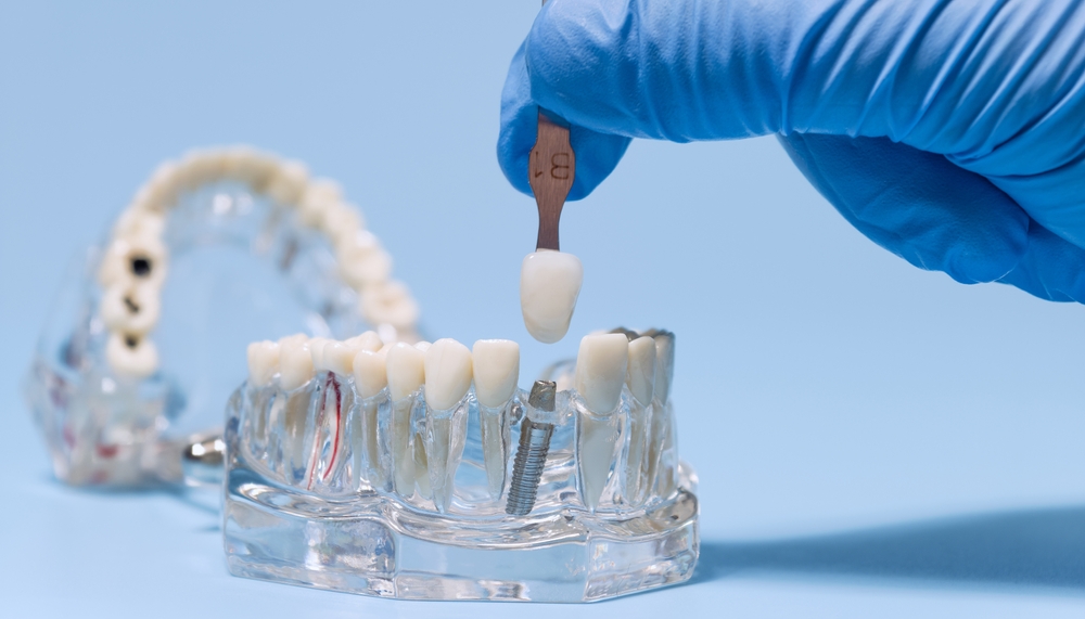 Dental Implants